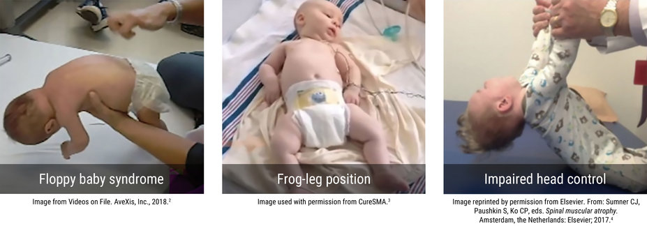 A triptych of infants in a hospital setting displaying signs of SMA. First image shows floppy baby syndrome, the second frog-leg position, and the third impaired head control.