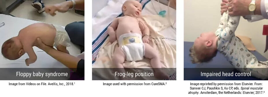 A triptych of infants in a hospital setting displaying signs of SMA. First image shows floppy baby syndrome, the second frog-leg position, and the third impaired head control.